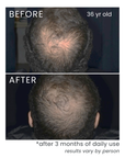 treatment for hair thinning